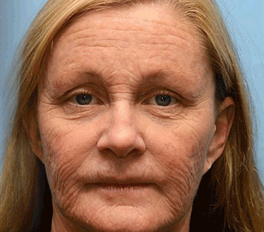 𝗛𝗲𝗮𝗹𝗿𝗶𝘇𝗲® 𝗕𝗼𝘁𝗼𝘅 & 𝗩𝗶𝘁𝗮-𝗔 𝗥𝗲𝘁𝗶𝗻𝗼𝗹 𝗦𝗵𝗼𝘁 𝗪𝗿𝗶𝗻𝗸𝗹𝗲-𝗟𝗶𝗳𝘁 𝗧𝗶𝗴𝗵𝘁𝗲𝗻𝗶𝗻𝗴 𝗰𝗿𝗲𝗮𝗺 - 𝗟𝗮𝘀𝘁 𝗗𝗮𝘆 𝗣𝗿𝗼𝗺𝗼𝘁𝗶𝗼𝗻 𝟴𝟬% 𝗢𝗙𝗙 |🌾🐳 𝗠𝗮𝗱𝗲 𝗮𝗻𝗱 𝘀𝗵𝗶𝗽𝗽𝗲𝗱 𝗳𝗿𝗼𝗺 AU